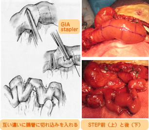 短腸症候群に対する腸管延長術(STEP)前後