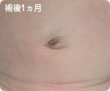 術後1カ月