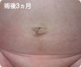 術後3カ月