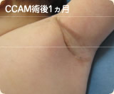 CCAM術後1ヵ月