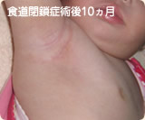 食道閉鎖症術後10ヵ月